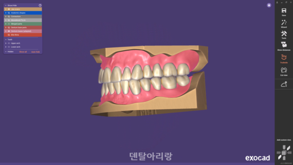 이미지(출처: exocad)