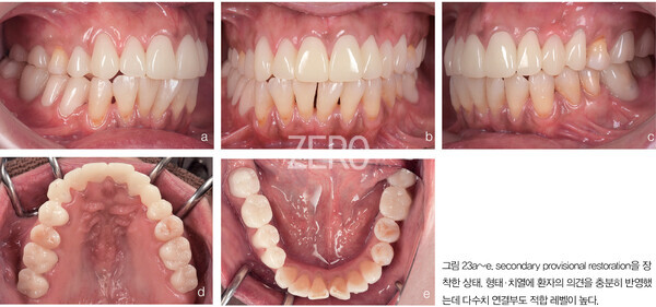 그림 23a~e. secondary provisional restoration을 장착한 상태. 형태·치열에 환자의 의견을 충분히 반영했는데 다수치 연결부도 적합 레벨이 높다.