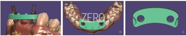 그림 31a~c. zirconia verification index 설계 종료. 장착 방향을 확인하고 매칭하기 위해 매칭 포인트를 설계한다. 중간결손이므로 인접치 사이에서 안정되도록 설계했다.